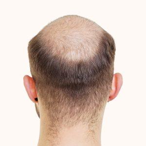 hair transplant