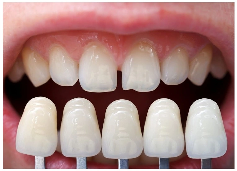 Different Types of Dental Veneers