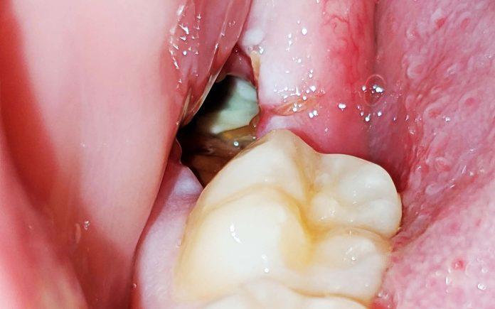 healing wisdom tooth socket