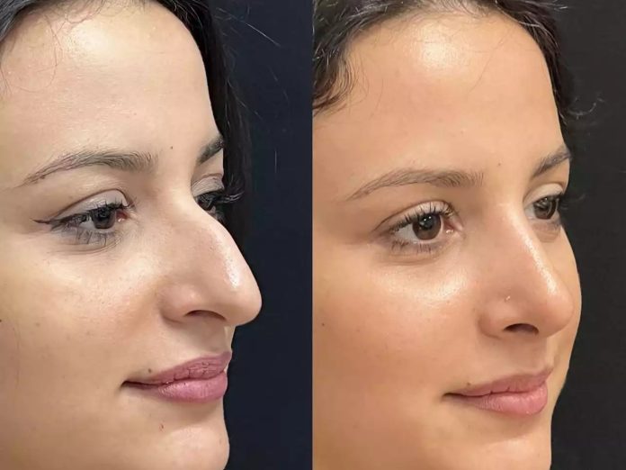 H-Rhinoplasty-10 Rhinoplasty in Dubai