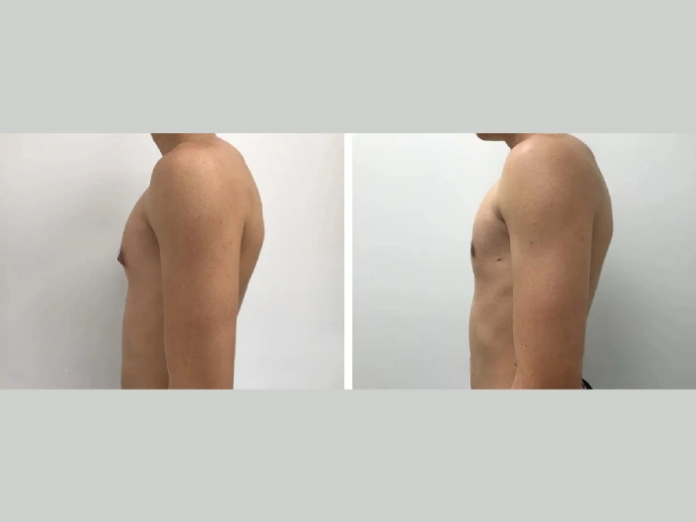 gynecomastia surgeon in dubai