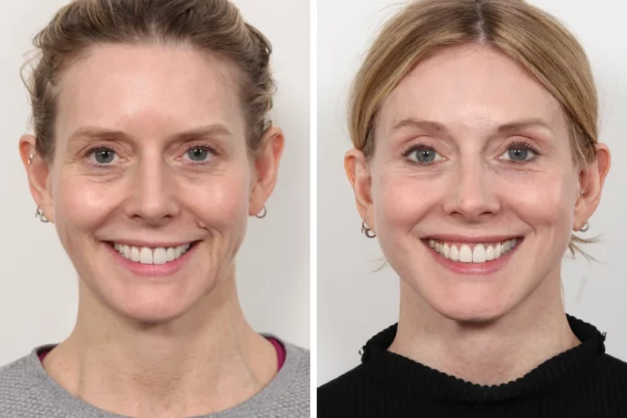 H14-Thread-Lift How Thread Lift in Dubai Can Boost Your Confidence