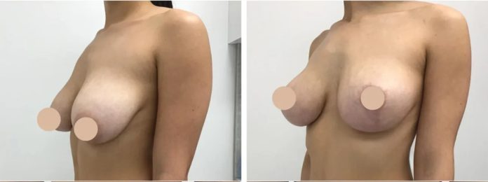 breast lift in dubai