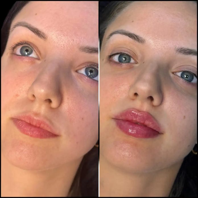 H5-lip-fillers (Fillers in Dubai) Fillers in dubai