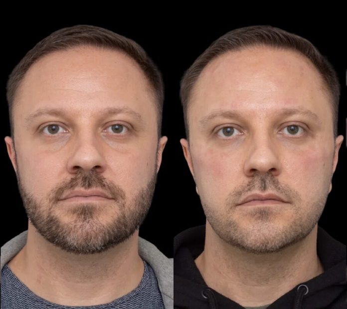 Under Eye Fillers in Dubai