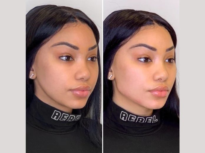 Experience Natural Beauty Transformation With Safe Advanced Thread Lift in Dubai Today