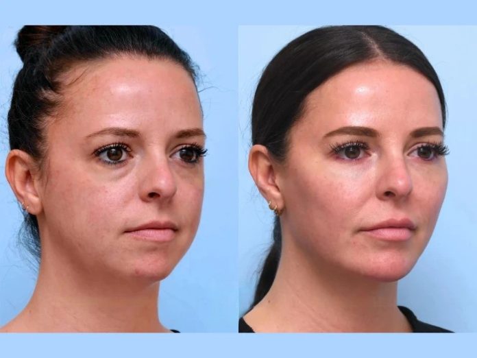 Defy Aging Signs Non-Surgically Using Modern Thread Lift Treatment in Dubai Beauty Solutions