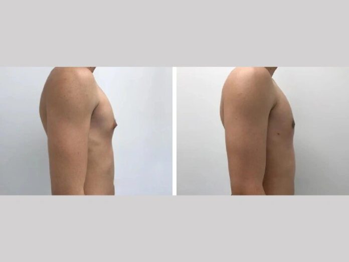 gynecomastia in dubai