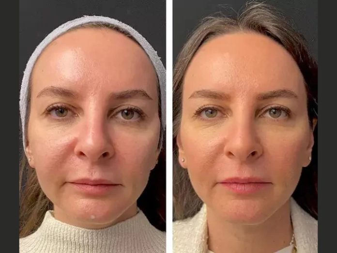 Mesotherapy Mesotherapy in Dubai