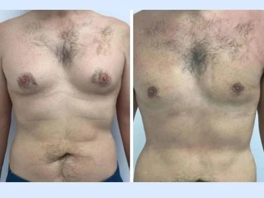gynecomastia-in-dubai (1) gynecomastia in dubai