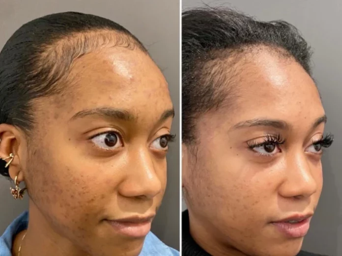 H4-Chemical-Peel