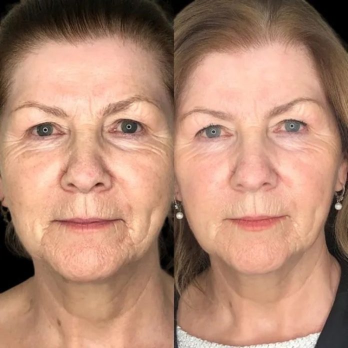 Profhilo in Dubai Profhilo in Dubai