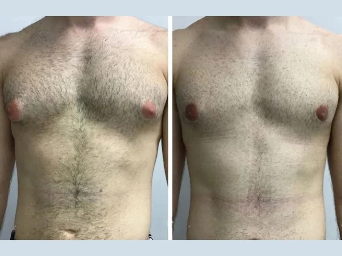 Natural Remedies vs Gynecomastia Surgery in Dubai: What Works Best?