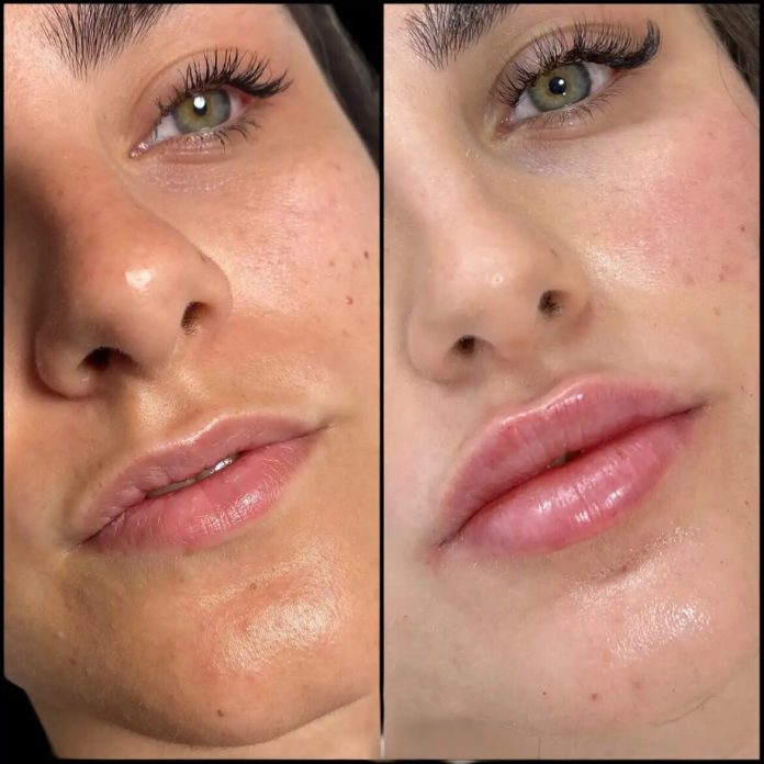 H8-lip-fillers-1170x1170 dermal fillers in dubai