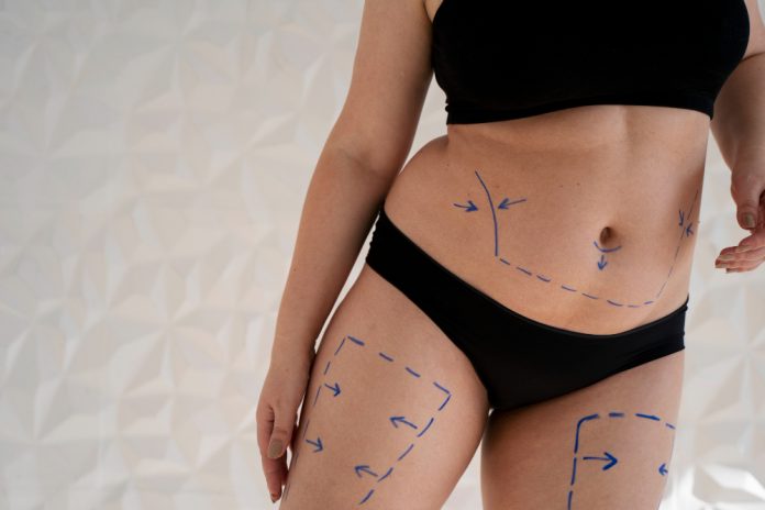 Liposuction High Definition Liposuction in Dubai