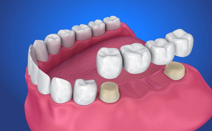 Dental Crowns in Flagstaff, AZ