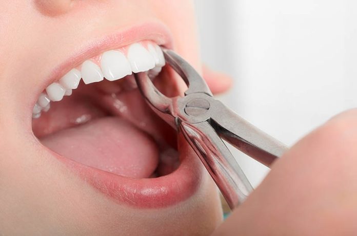 Tooth Extractions in Phoenix, AZ