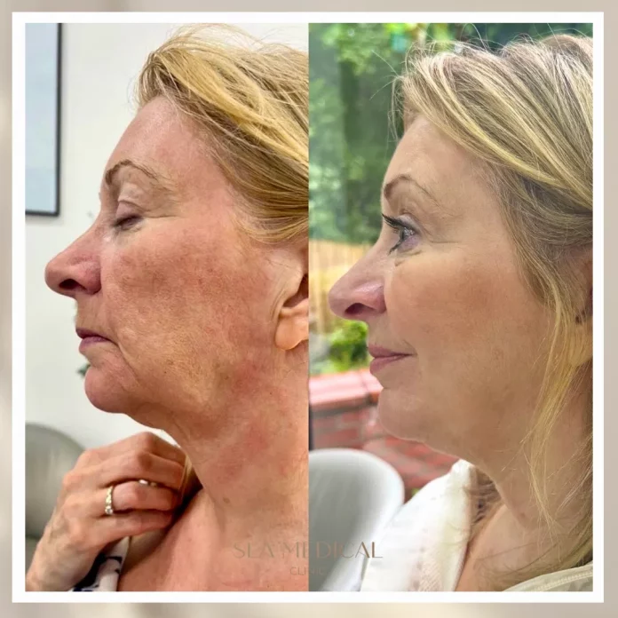 rose Rosacea In Manchester