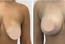 Feel Beautiful Again with the Best Breast Reduction Surgeons in dubai