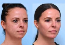 Best Doctors in Dubai Prefer Thread Lift Offers Effective Results without Downtime Best Doctors in Dubai Prefer Thread Lift Offers Effective Results without Downtime