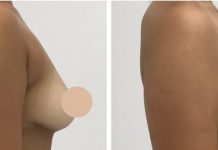 Confidence and Care with the Best Breast Lift Surgeons in dubai
