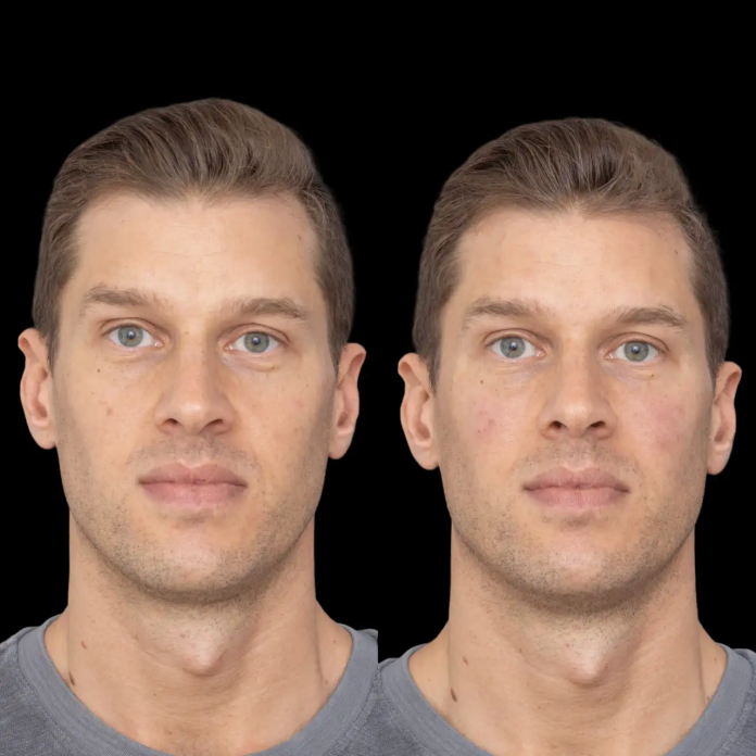 Jawline Fillers in Dubai Jawline Fillers in Dubai