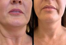 Profhilo treatments in dubai