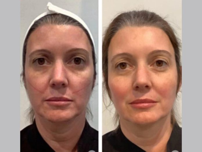H4-Thread-Lift1-ezgif.com-webp-to-jpg-converter Best Aesthetic Clinics in Dubai Delivering Cutting-Edge Thread Lift
