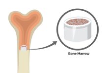 Innovations in Bone Marrow Transplantation: What’s New?