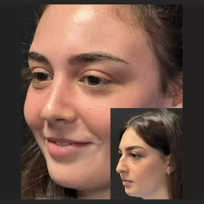 Rhinoplasty in dubai