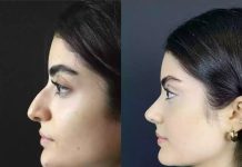 Behind the Results: Techniques Used by the Best Rhinoplasty Surgeons in Dubai