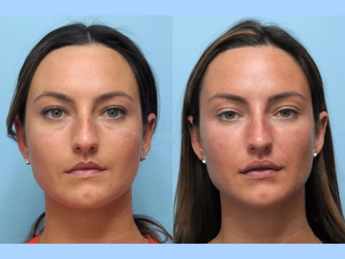 Best Doctors in Dubai for Thread Lift to Achieve a Defined Jawline Best Doctors in Dubai for Thread Lift to Achieve a Defined Jawline