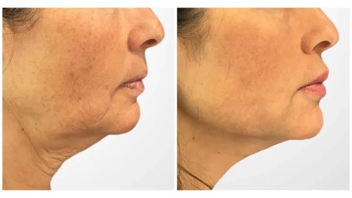 Top Best Doctors in Dubai for Thread Lift: A Younger, Firmer, More Defined Face