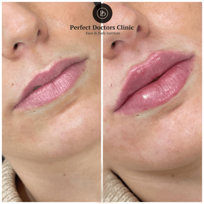 Juvederm in Dubai