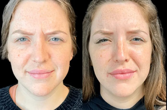 Best Doctors in Dubai Discuss Botox for Crow’s Feet and Eye Area