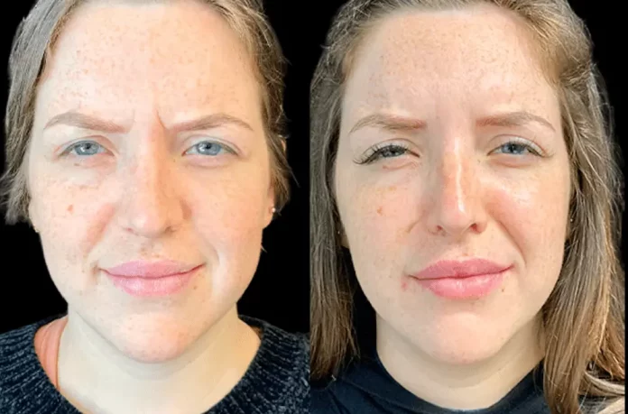 Why Botox in Dubai Is Popular for Wrinkle Reduction