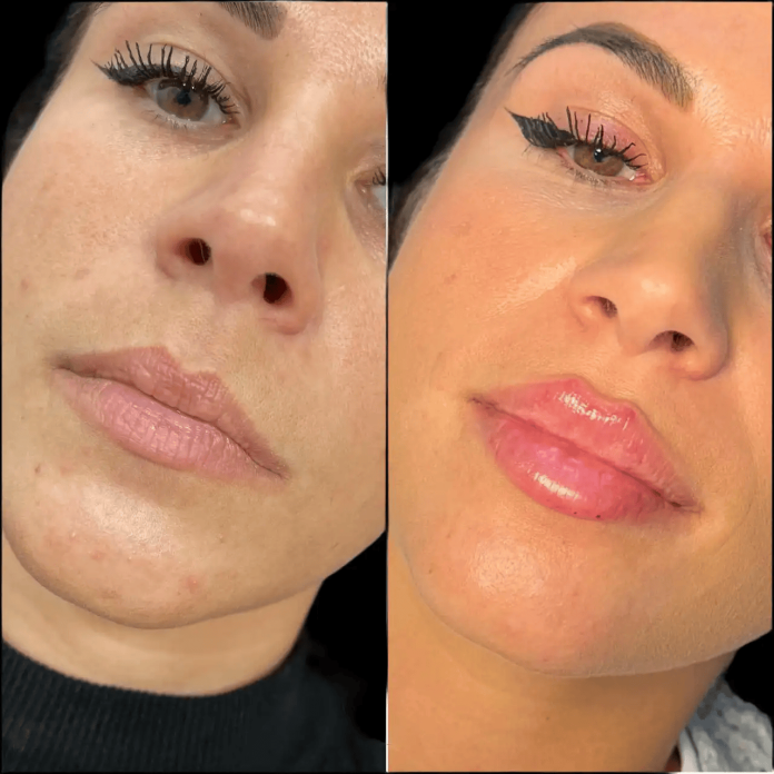Russian Lip Fillers Russian Lip Fillers
