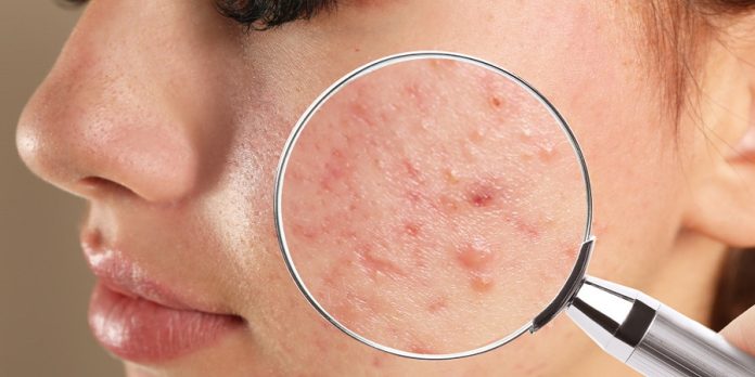 Acne Treatment in Riyadh Acne Treatment in Riyadh