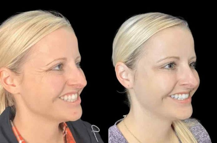Botox in Dubai Botox in Dubai