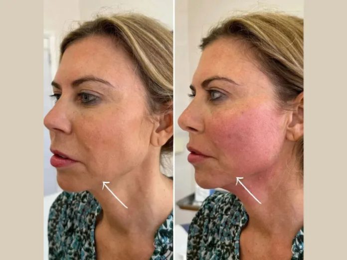 H1-Endolift Best Doctors in dubai Transforming Beauty with Endolift Technology