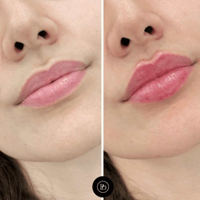 Juvederm in Dubai Juvederm in Dubai