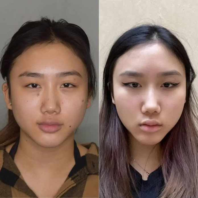 Buccal Fat Removal in dubai Buccal Fat Removal in dubai