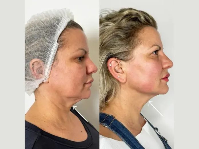 H5-Endolift Best Aesthetic Clinic in dubai for Natural-Looking Endolift Results