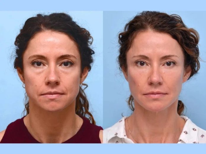 Best Plastic Surgeons in Dubai Presenting Advanced Thread Lift