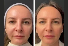 Mesotherapy Treatment in Dubai: Hyperpigmentation Treatment Mesotherapy in dubai