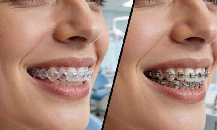 invisalign-vs-braces-for-adults