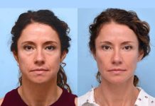 Best Aesthetic Clinics in Dubai Ensuring Precision in Thread Lift Treatments