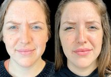 Choosing Botox Safely at Best Aesthetic Clinics in dubai Botox in Dubai