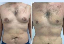 Gynecomastia in dubai