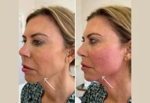 Best Doctors in dubai for Innovative Endolift Facial Contouring Technology